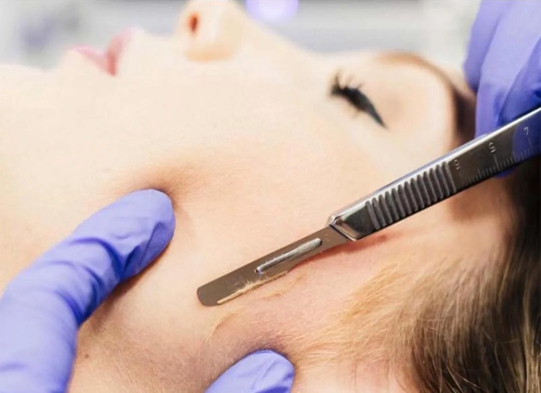 Imagen de Dermaplaning en Maradia Estética