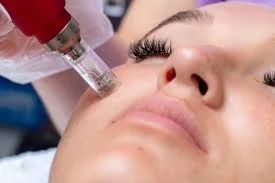 Imagen de Microneedling (Dermapen) en Maradia Estética